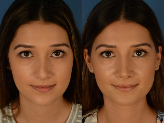 Revision Rhinoplasty Before and After Photos in Naples, FL, Patient 14996