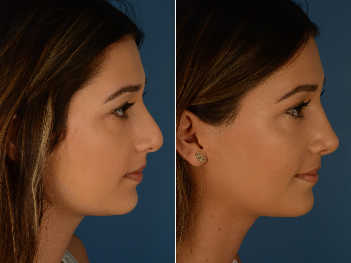 Revision Rhinoplasty Before and After Photos in Naples, FL, Patient 14996