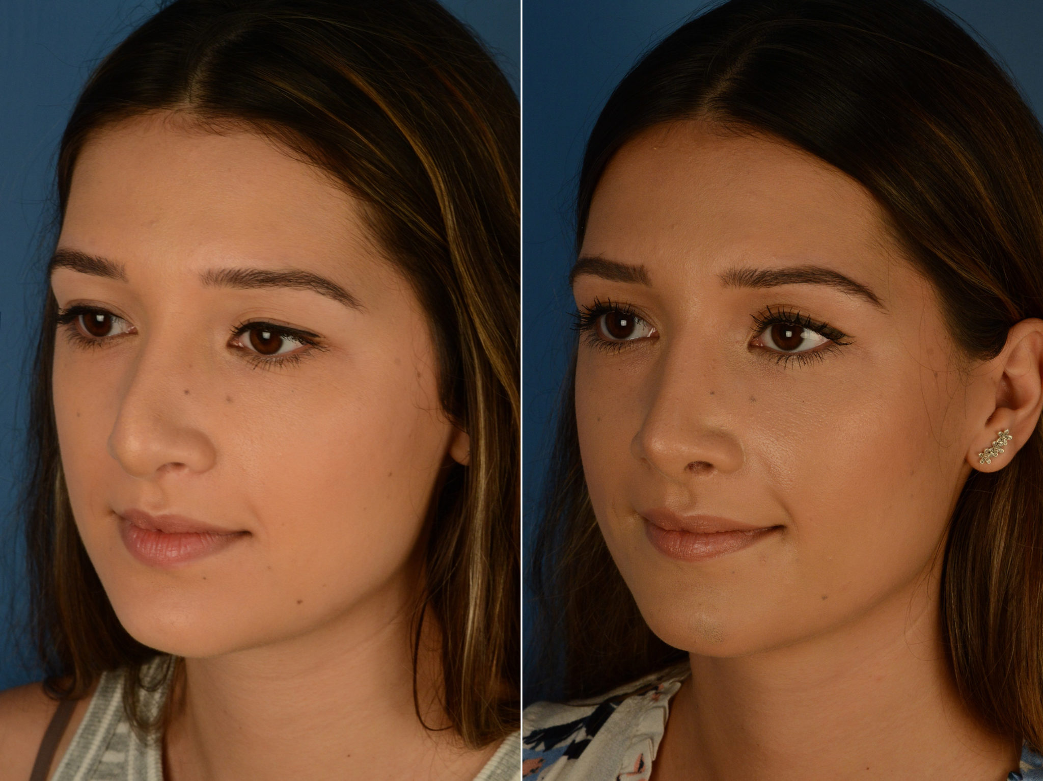 Revision Rhinoplasty Photos Naples, FL Patient 14996