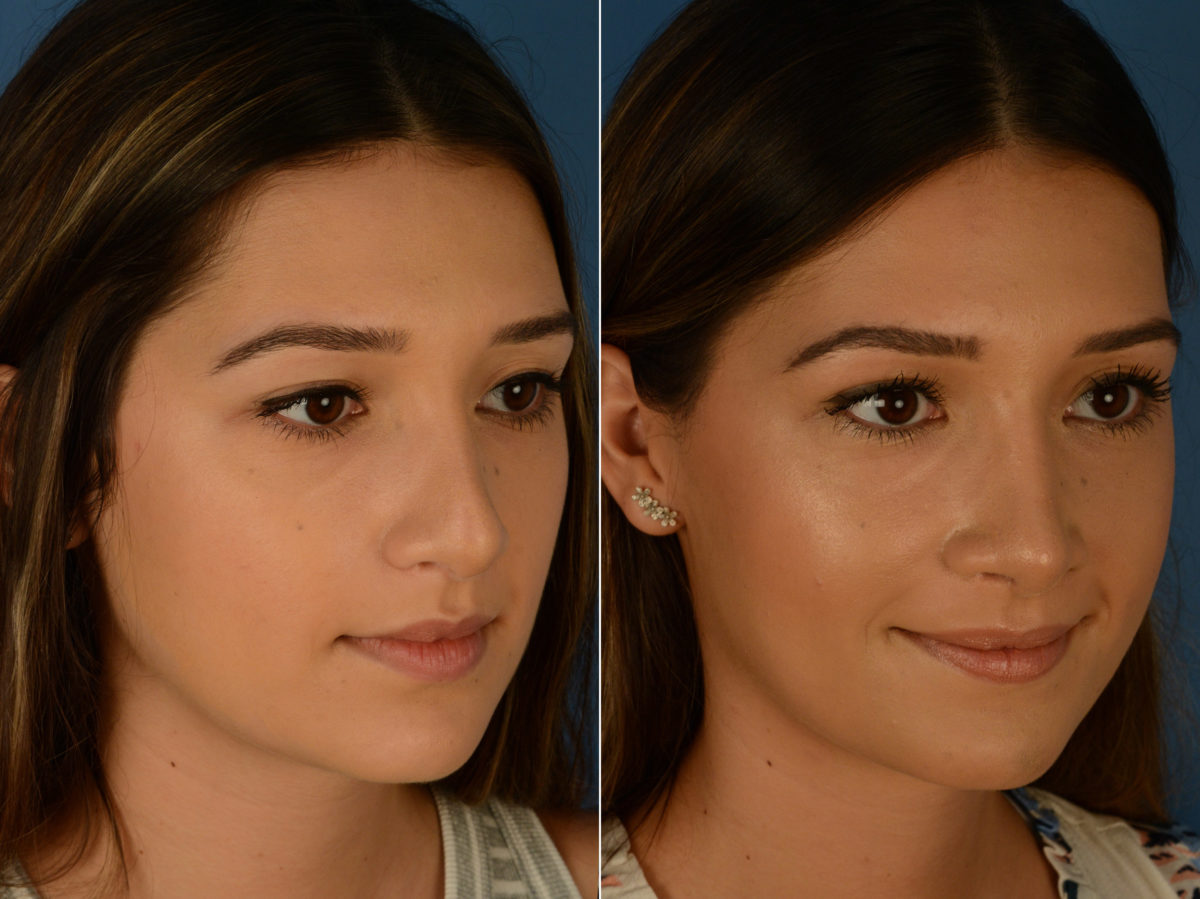 Revision Rhinoplasty Before and After Photos in Naples, FL, Patient 14996