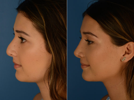 Revision Rhinoplasty Before and After Photos in Naples, FL, Patient 14996