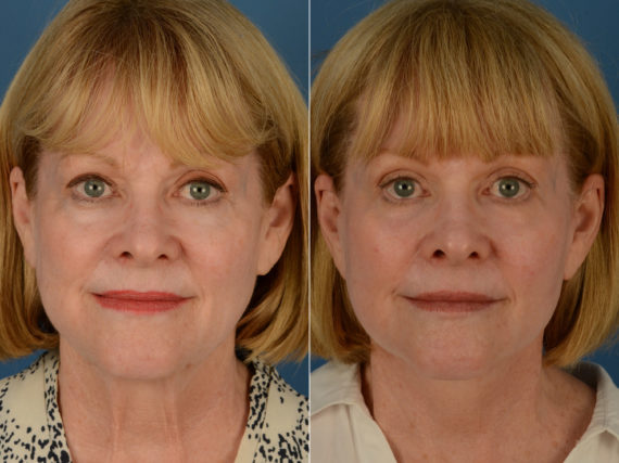 The UpLift™ Lower Face and Neck Lift Before and After Photos in Naples, FL, Patient 15018