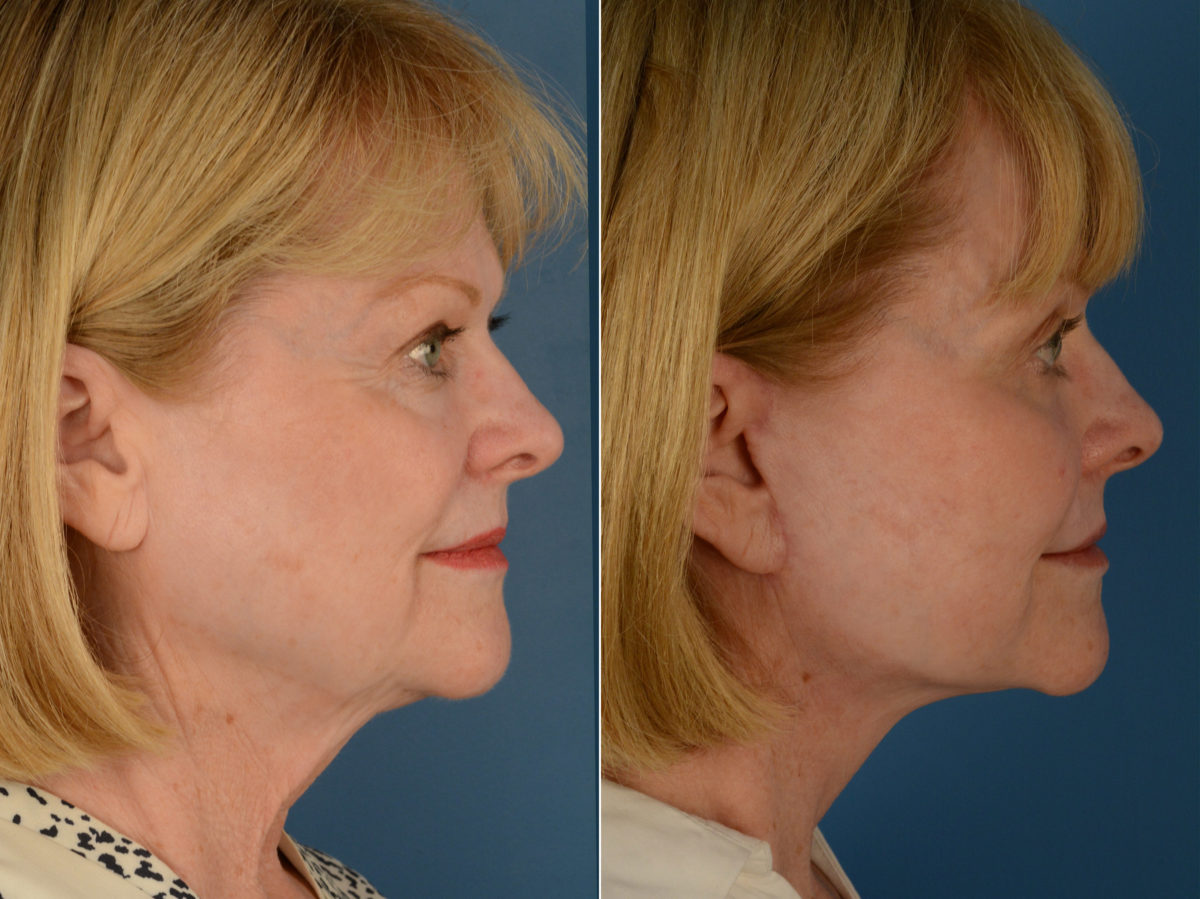 The UpLift™ Lower Face and Neck Lift Before and After Photos in Naples, FL, Patient 15018