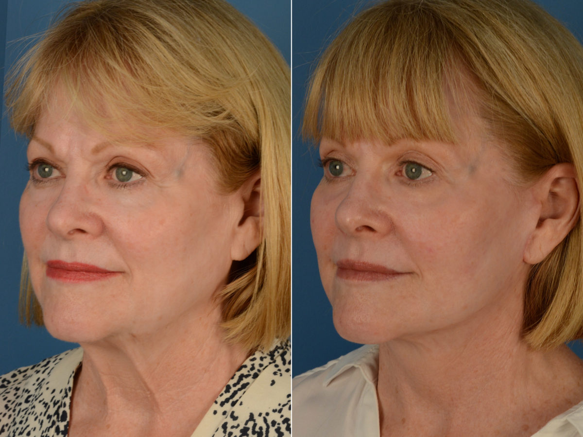 The UpLift™ Lower Face and Neck Lift Before and After Photos in Naples, FL, Patient 15018