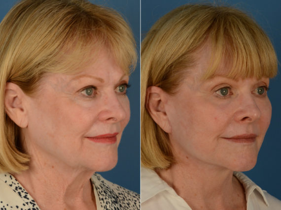 The UpLift™ Lower Face and Neck Lift Before and After Photos in Naples, FL, Patient 15018