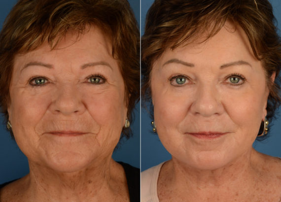 Endoscopic Facelift Before and After Photos in Naples, FL, Patient 15048