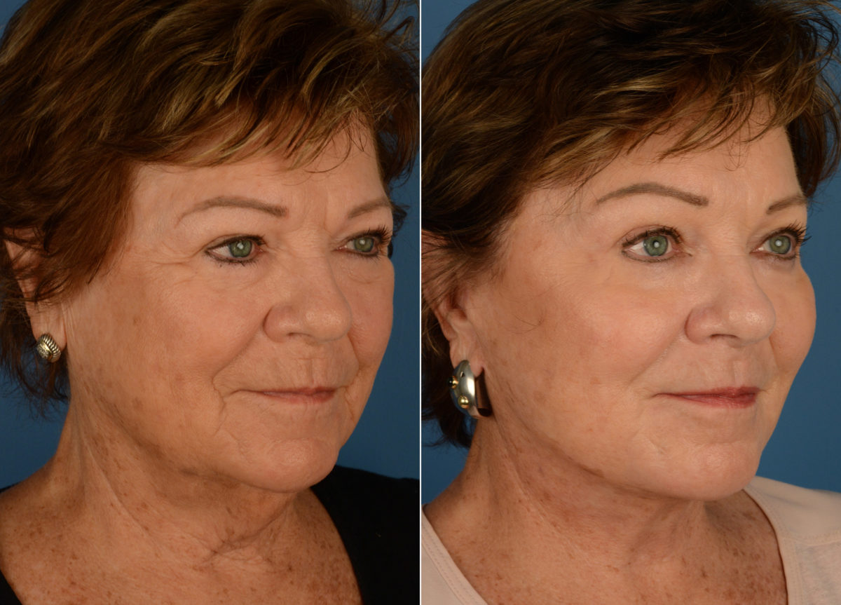 Endoscopic Facelift Before and After Photos in Naples, FL, Patient 15048