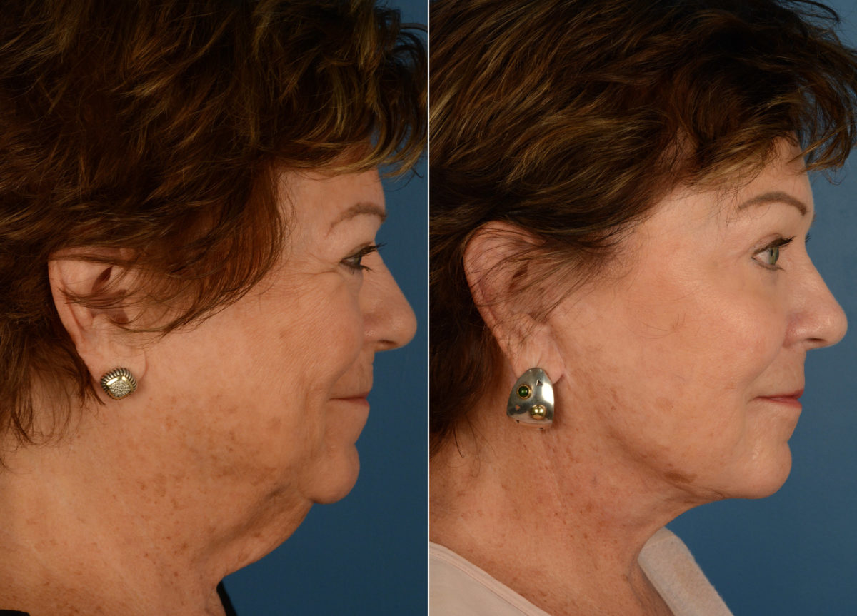 Endoscopic Facelift Before and After Photos in Naples, FL, Patient 15048