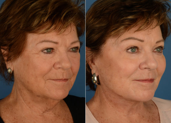 Endoscopic Facelift Before and After Photos in Naples, FL, Patient 15048