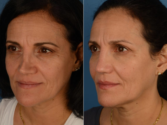 Revision Rhinoplasty Before and After Photos in Naples, FL, Patient 15073