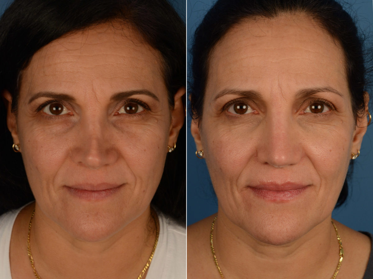 Revision Rhinoplasty Before and After Photos in Naples, FL, Patient 15073