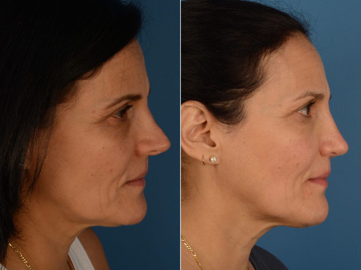 Revision Rhinoplasty Before and After Photos in Naples, FL, Patient 15073