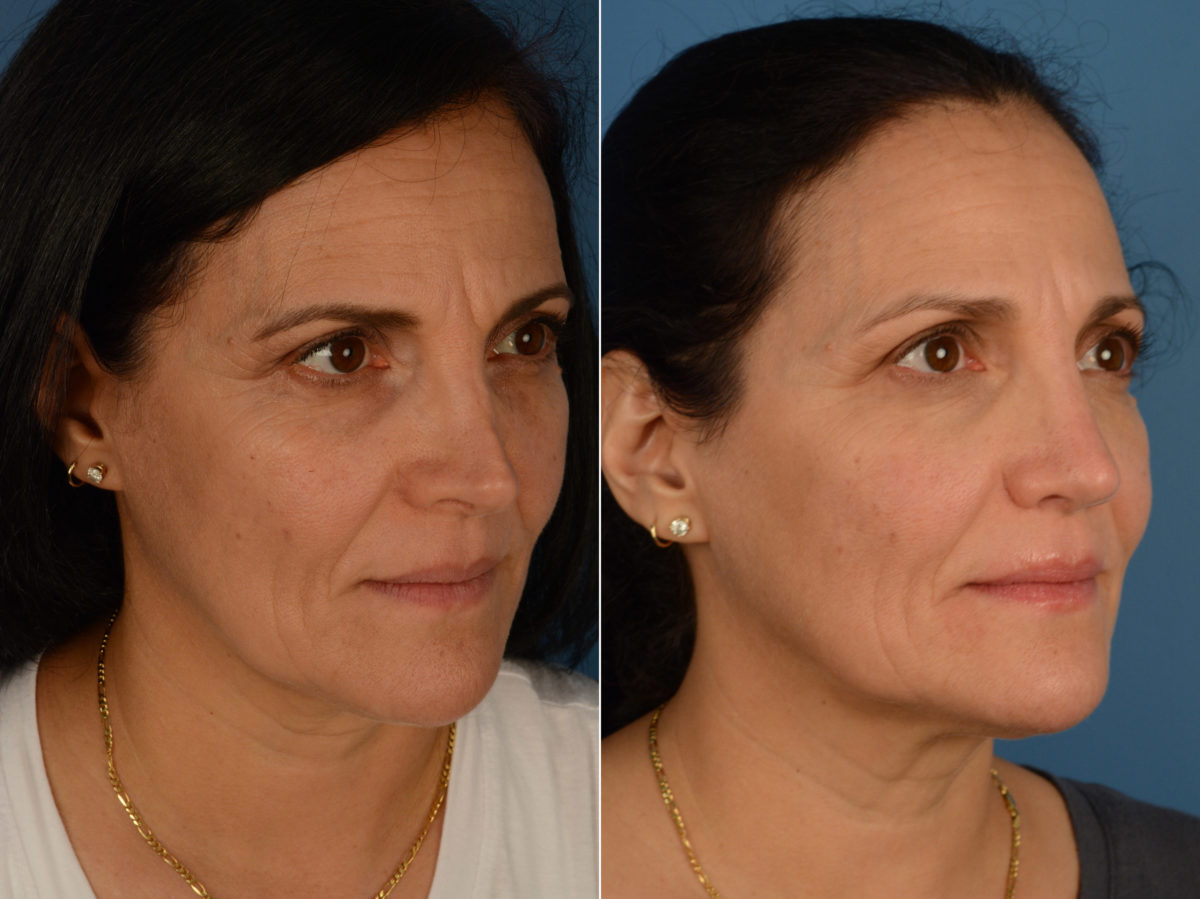 Revision Rhinoplasty Before and After Photos in Naples, FL, Patient 15073