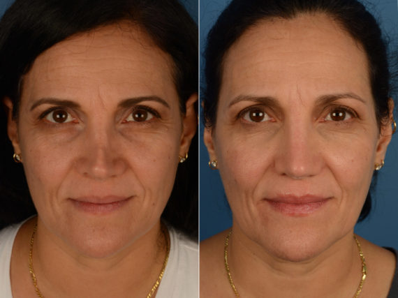 Revision Rhinoplasty Before and After Photos in Naples, FL, Patient 15073