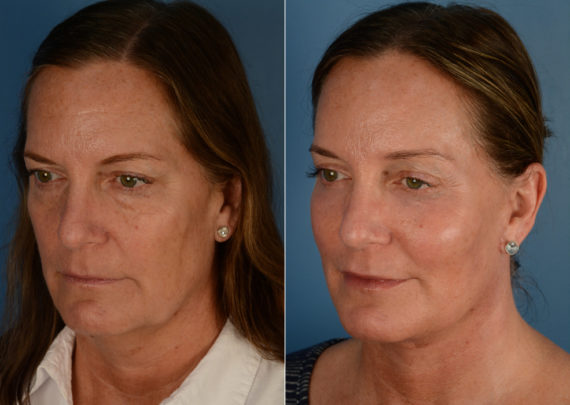 Endoscopic Facelift Before and After Photos in Naples, FL, Patient 15128