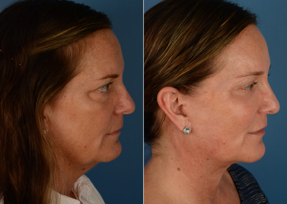 Endoscopic Facelift Before and After Photos in Naples, FL, Patient 15128
