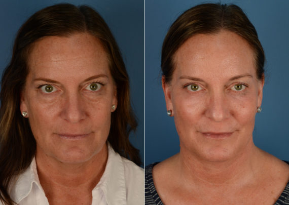 Endoscopic Facelift Before and After Photos in Naples, FL, Patient 15128