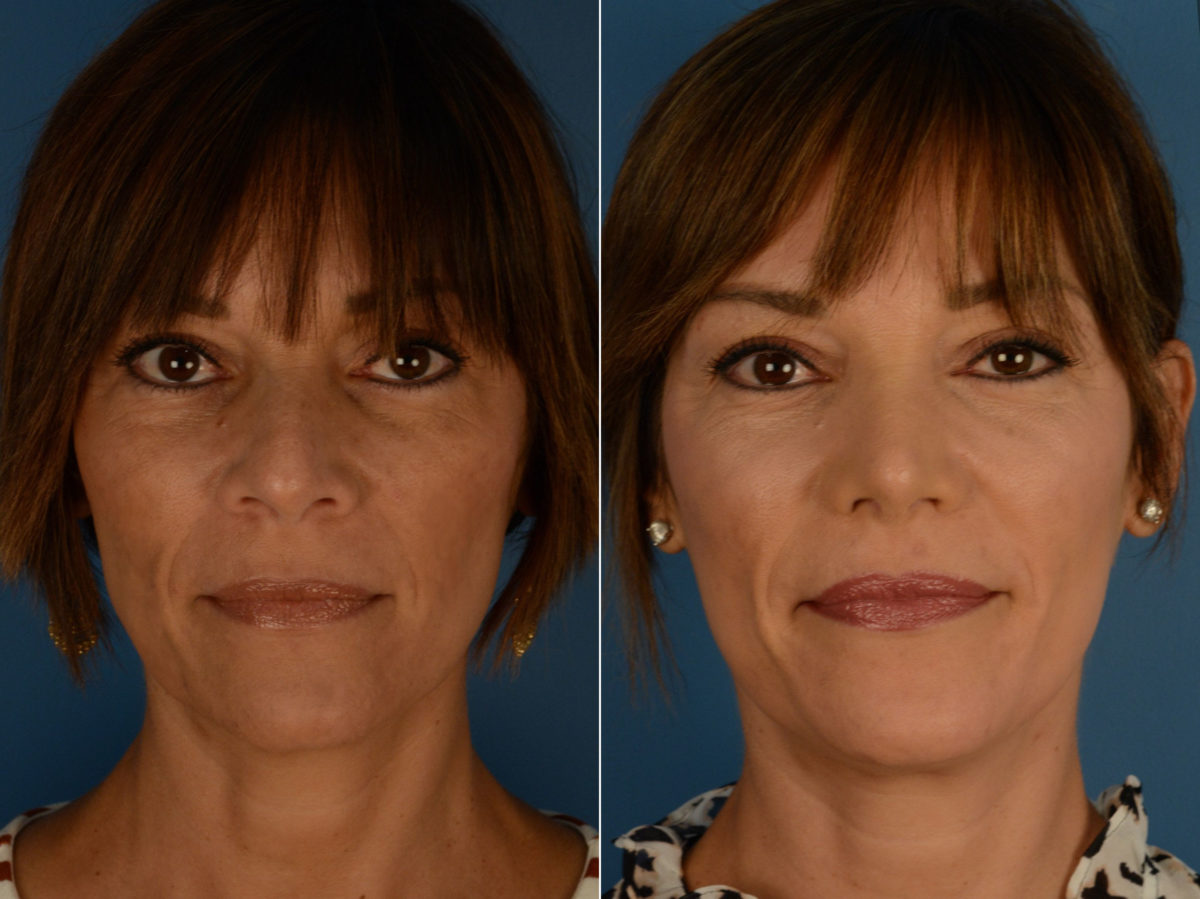 Revision Rhinoplasty Before and After Photos in Naples, FL, Patient 15158