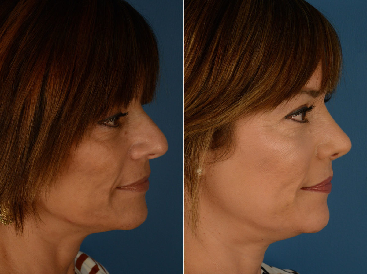 Revision Rhinoplasty Before and After Photos in Naples, FL, Patient 15158