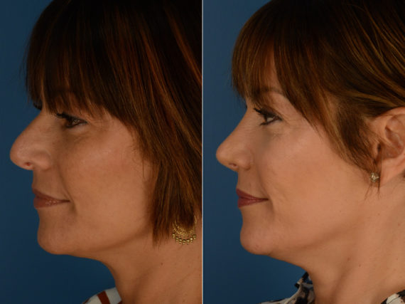 Revision Rhinoplasty Before and After Photos in Naples, FL, Patient 15158