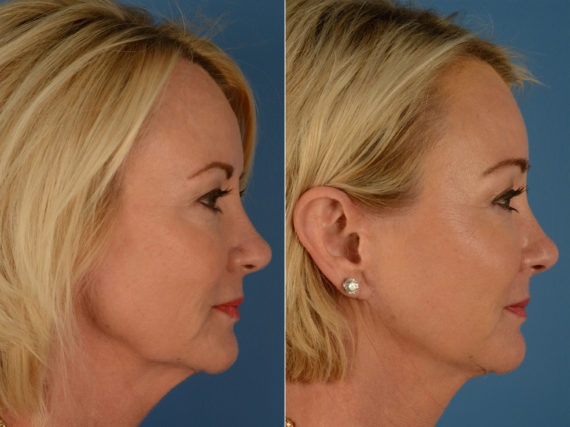 The UpLift™ Lower Face and Neck Lift Before and After Photos in Naples, FL, Patient 15169