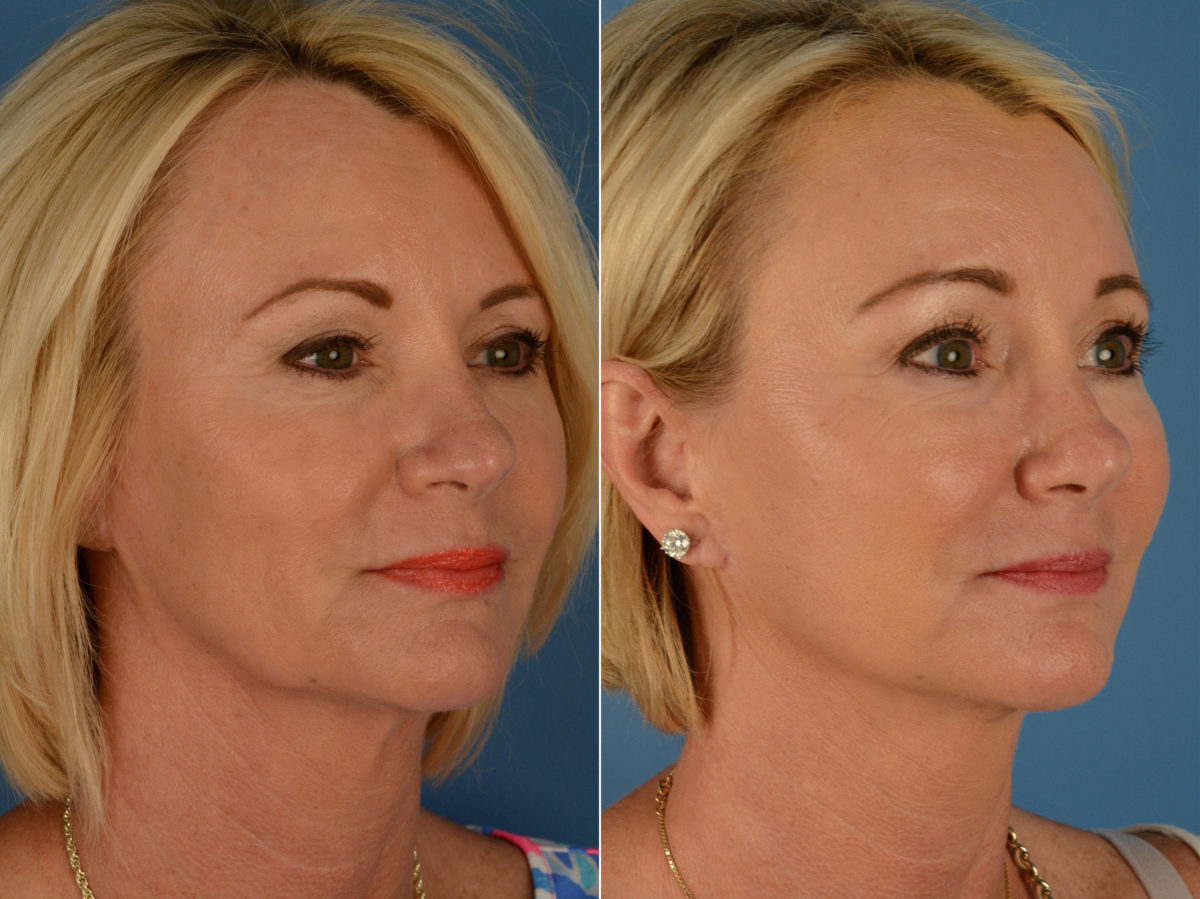 The UpLift™ Lower Face and Neck Lift Before and After Photos in Naples, FL, Patient 15169