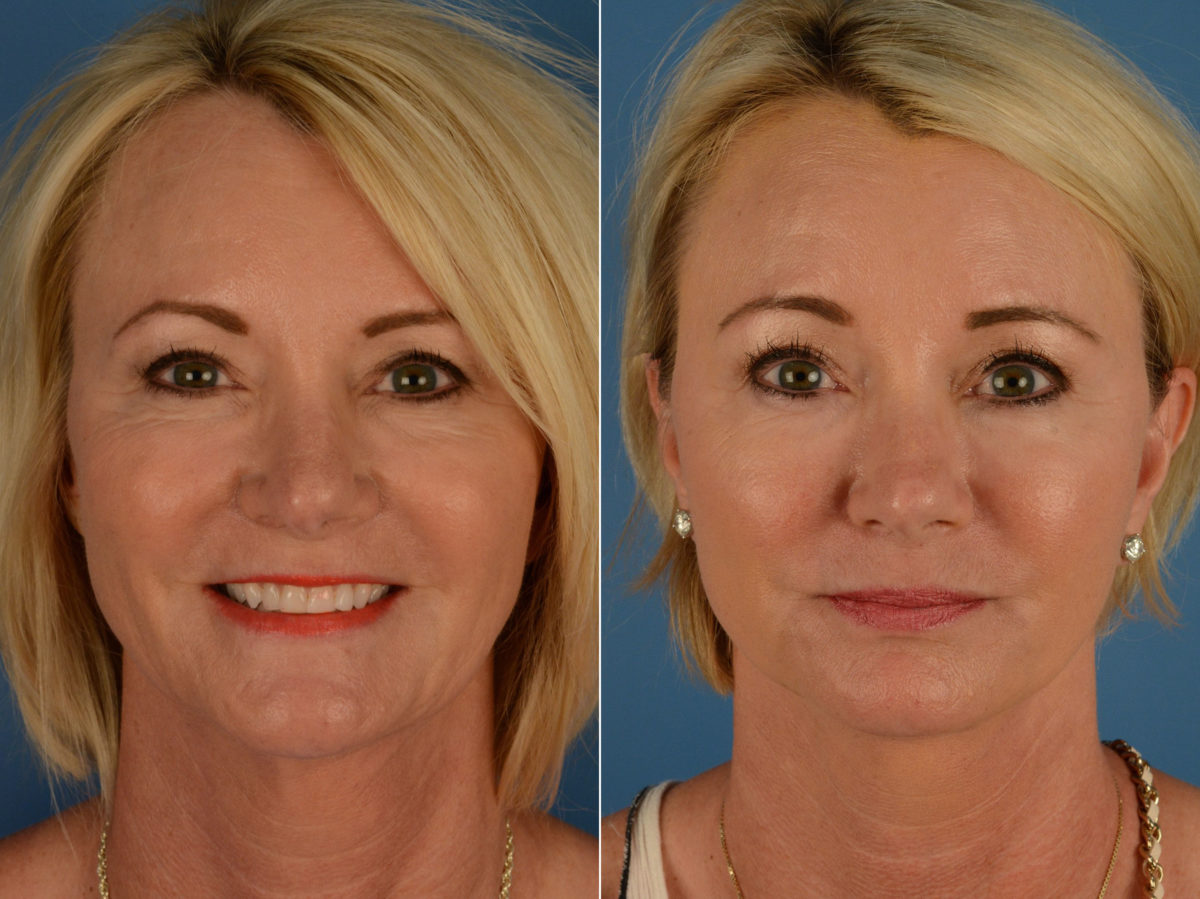 The UpLift™ Lower Face and Neck Lift Before and After Photos in Naples, FL, Patient 15169