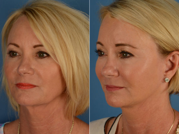 The UpLift™ Lower Face and Neck Lift Before and After Photos in Naples, FL, Patient 15169