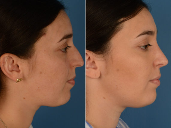 Rhinoplasty Before and After Photos in Naples, FL, Patient 15255