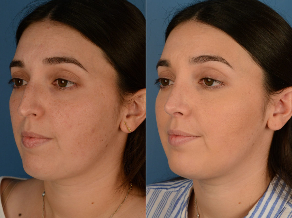 Rhinoplasty Before and After Photos in Naples, FL, Patient 15255