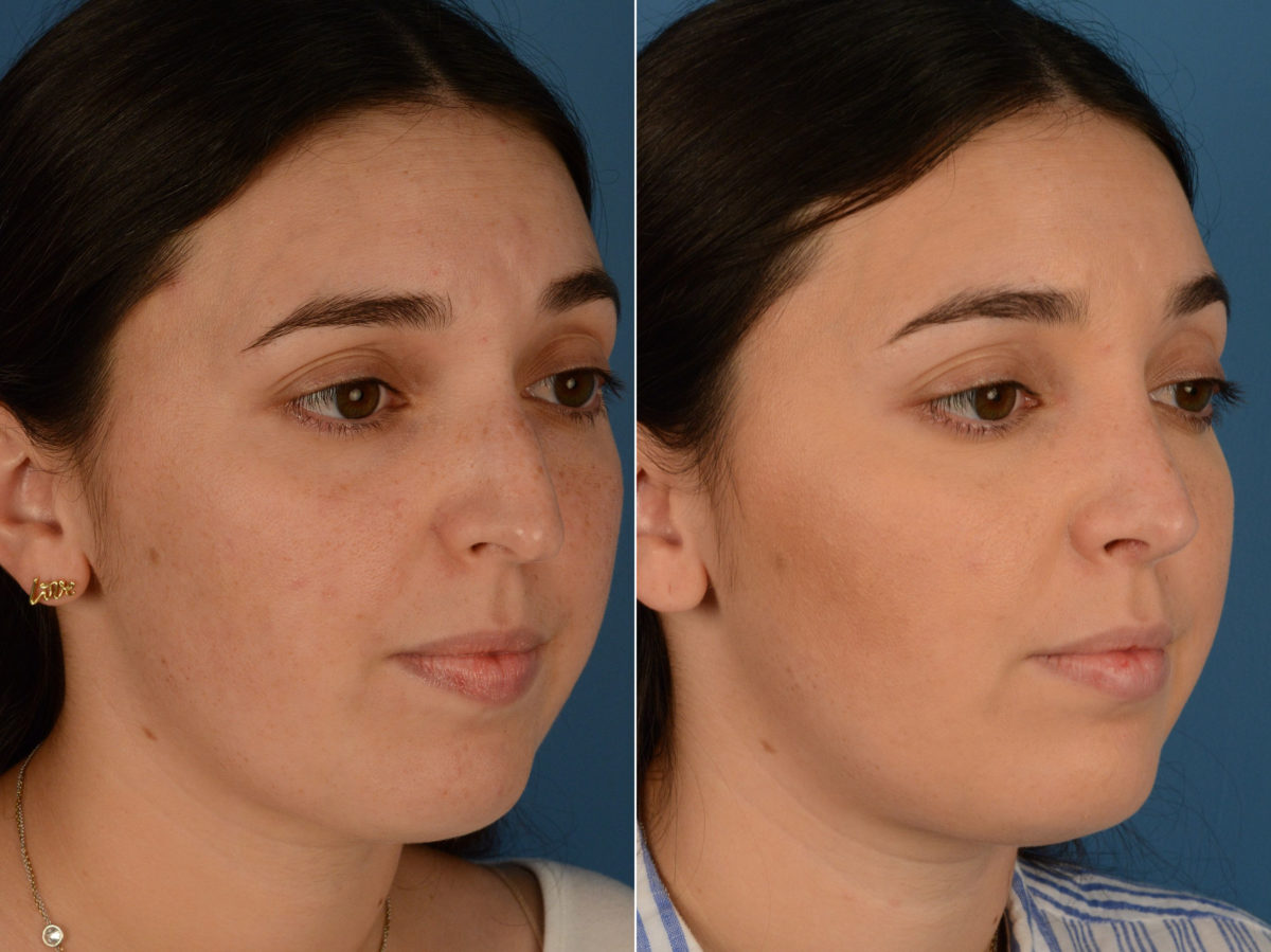 Rhinoplasty Before and After Photos in Naples, FL, Patient 15255