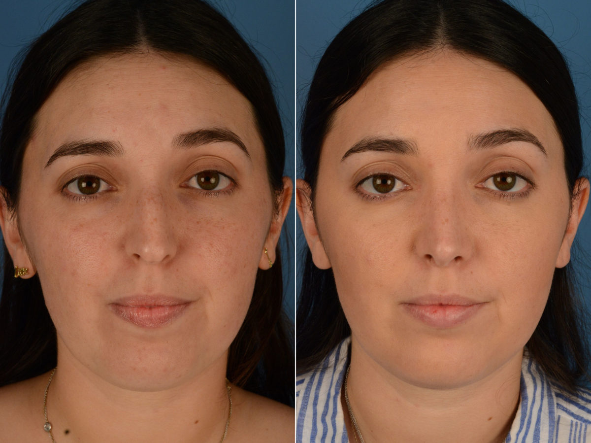 Rhinoplasty Before and After Photos in Naples, FL, Patient 15255