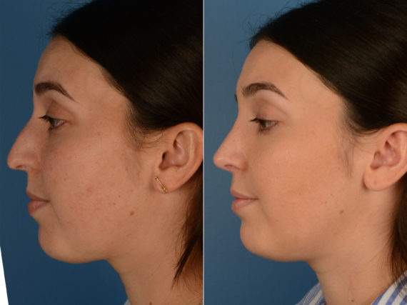 Rhinoplasty Before and After Photos in Naples, FL, Patient 15255