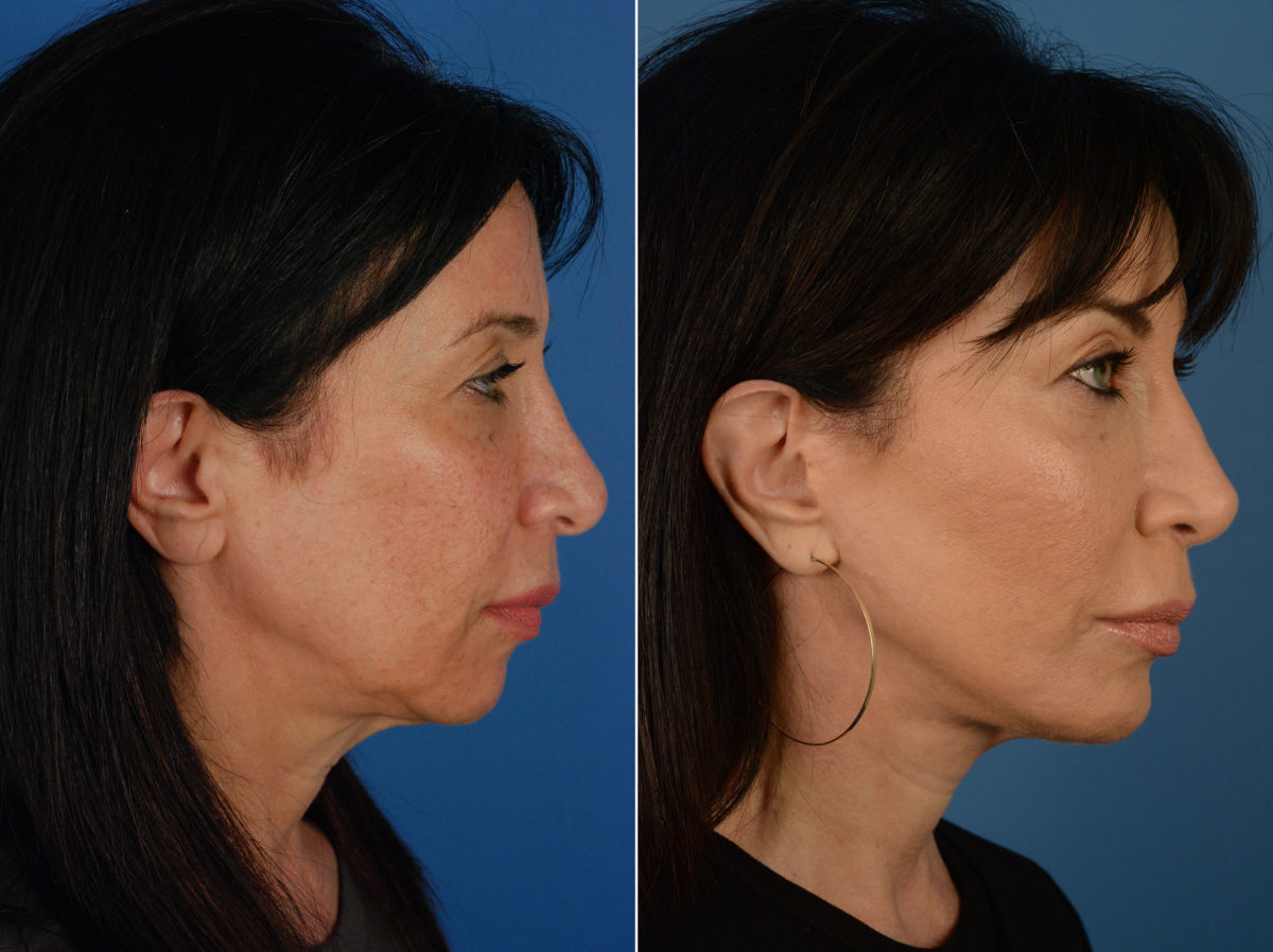 Revision Rhinoplasty Before and After Photos in Naples, FL, Patient 15287