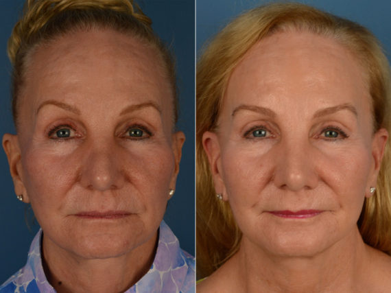 Revision Rhinoplasty Before and After Photos in Naples, FL, Patient 15334