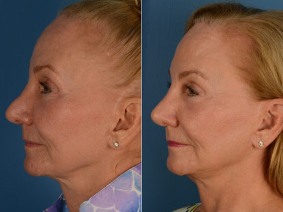 Revision Rhinoplasty Before and After Photos in Naples, FL, Patient 15334