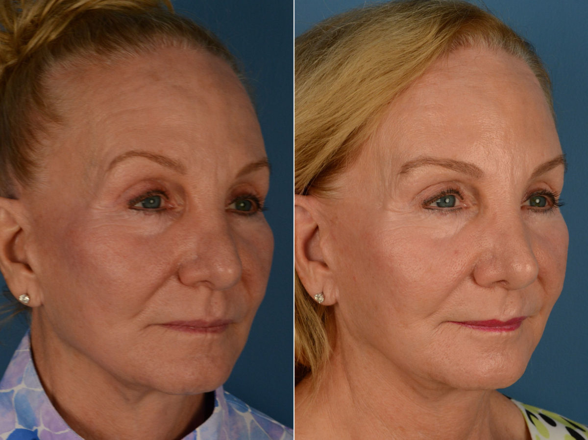 Revision Rhinoplasty Before and After Photos in Naples, FL, Patient 15334