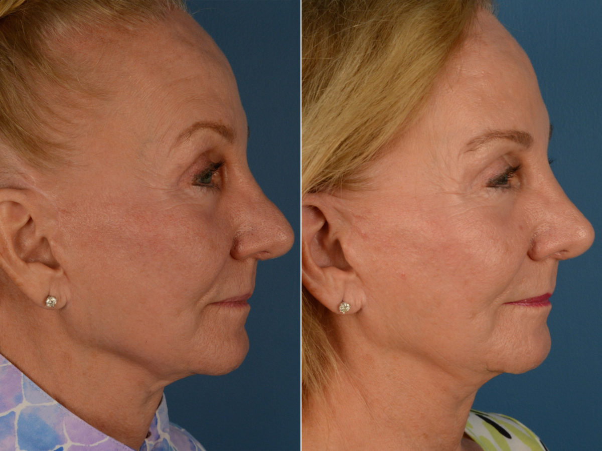 Revision Rhinoplasty Before and After Photos in Naples, FL, Patient 15334