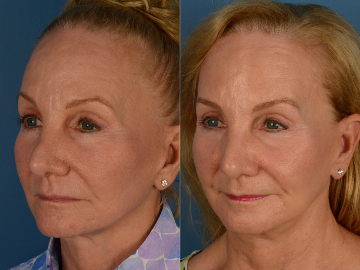 Revision Rhinoplasty Before and After Photos in Naples, FL, Patient 15334