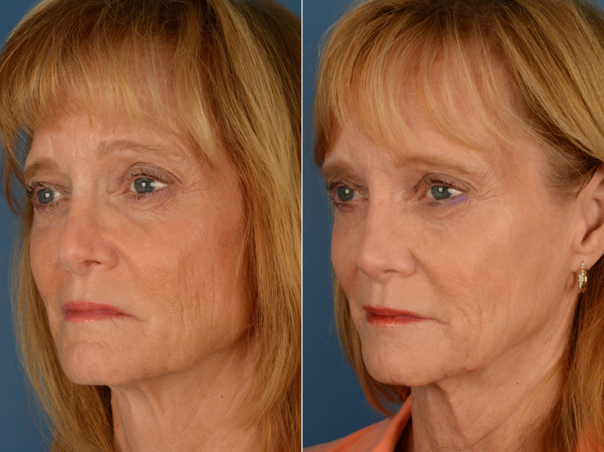 Revision Rhinoplasty Before and After Photos in Naples, FL, Patient 15418