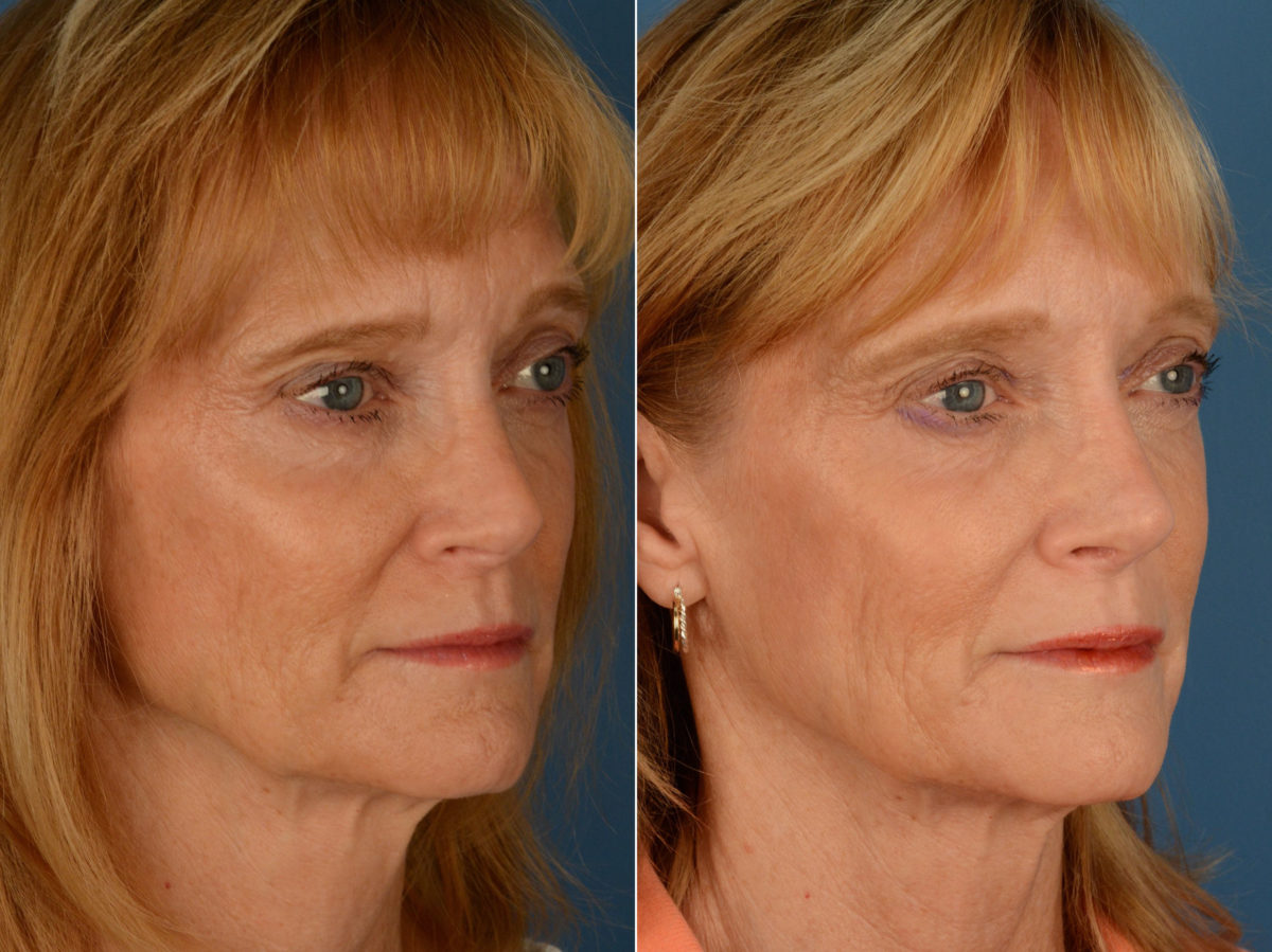 Revision Rhinoplasty Before and After Photos in Naples, FL, Patient 15418