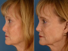 Revision Rhinoplasty Before and After Photos in Naples, FL, Patient 15418