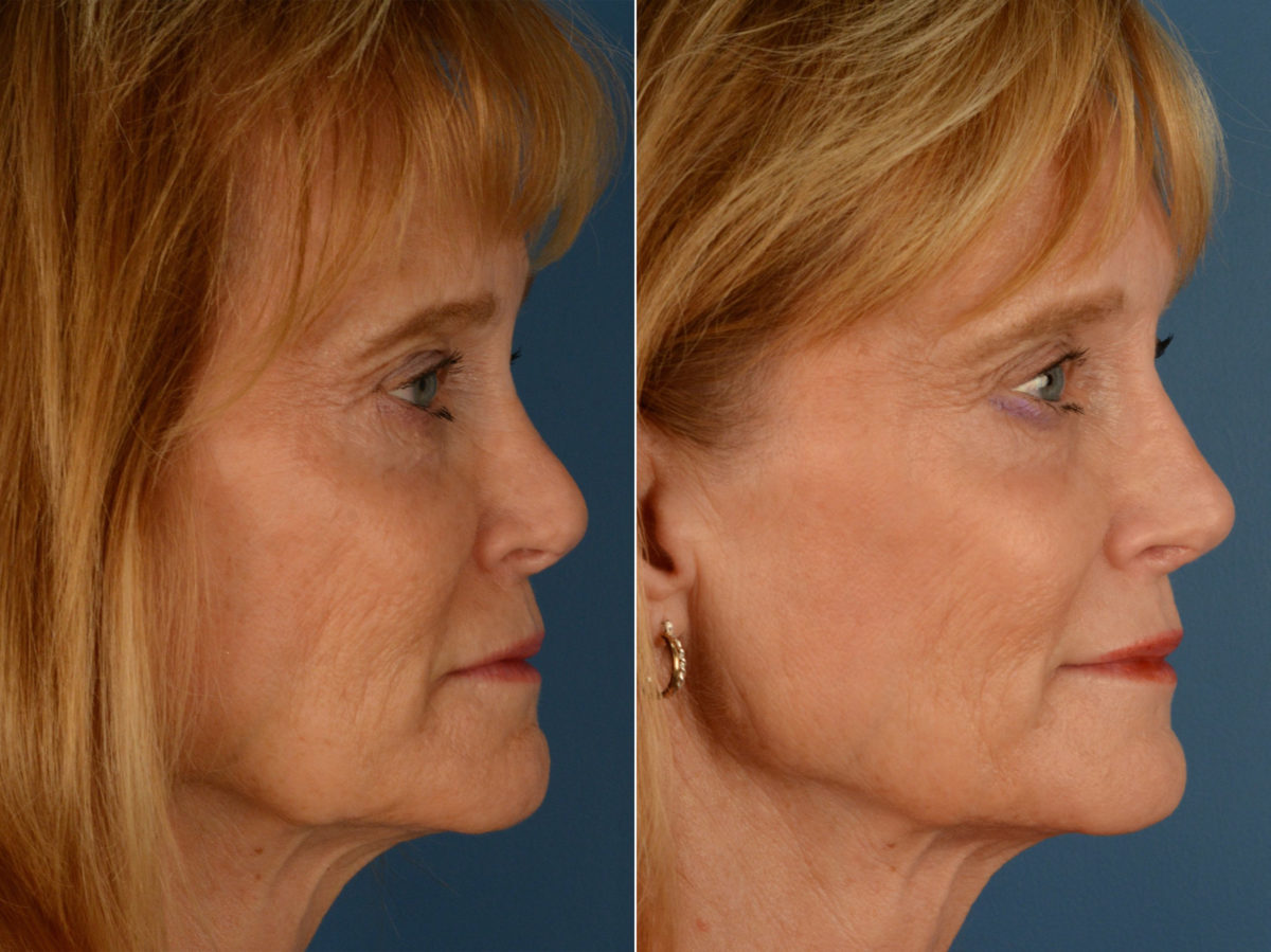 Revision Rhinoplasty Before and After Photos in Naples, FL, Patient 15418