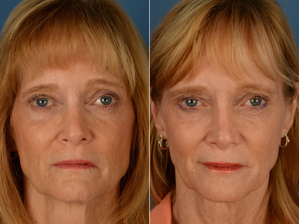 Revision Rhinoplasty Before and After Photos in Naples, FL, Patient 15418