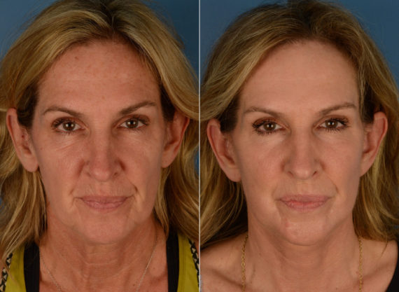 CO2 Laserwash Before and After Photos in Naples, FL, Patient 15468