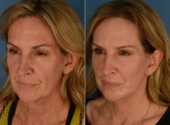 CO2 Laserwash Before and After Photos in Naples, FL, Patient 15468