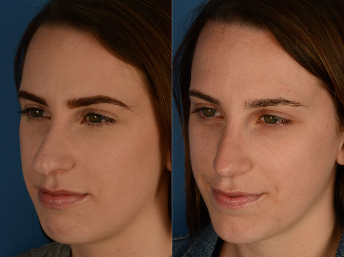 Rhinoplasty Before and After Photos in Naples, FL, Patient 15521