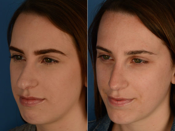 Rhinoplasty Before and After Photos in Naples, FL, Patient 15521