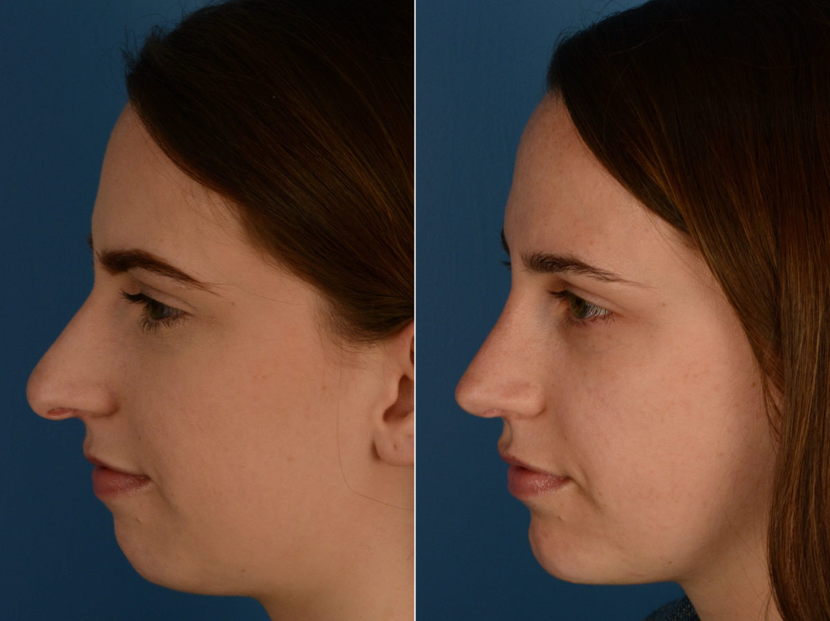 Rhinoplasty Before and After Photos in Naples, FL, Patient 15521