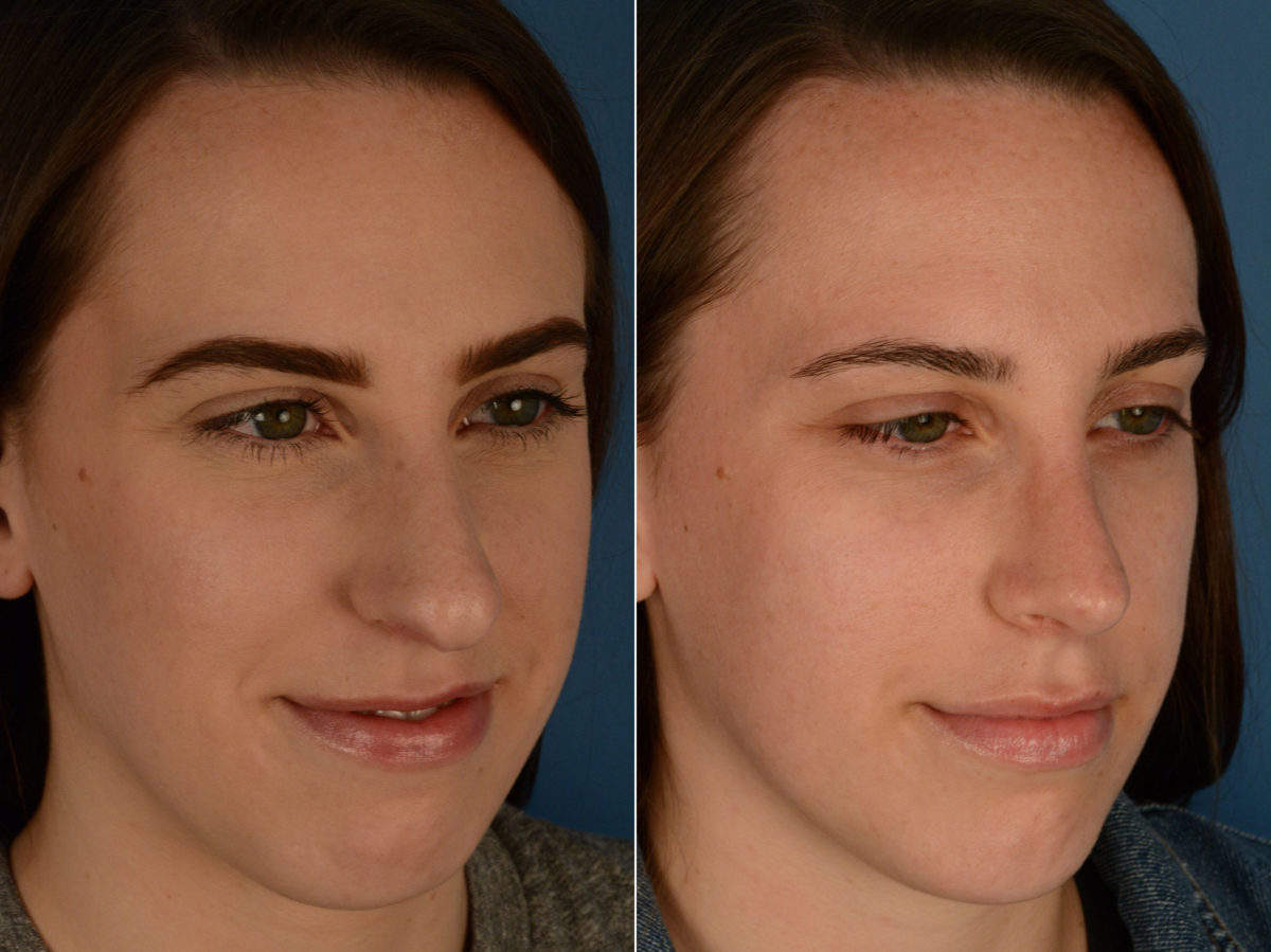 Rhinoplasty Before and After Photos in Naples, FL, Patient 15521